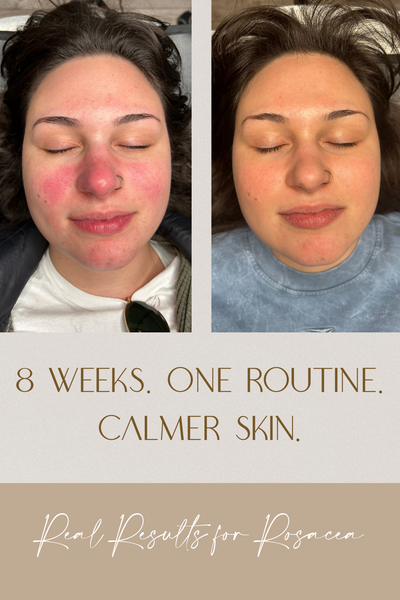 ✨ Real Results: 8 Weeks of Charcoal Skincare for Rosacea