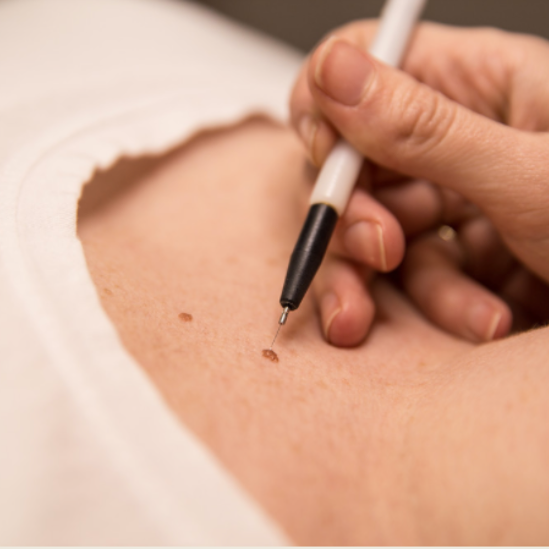 Our Service Epidermal Repair